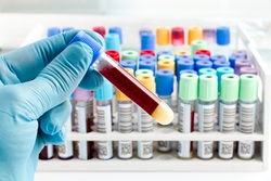 Hand of a lab technician holding blood tube test and background a rack of color tubes with blood samples other patients